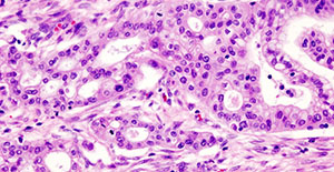 Pancreatic ductal adenocarcinoma is characterized by elevated levels of polyamines, a natural component for growth of all mammalian cells. Panbela is studying the effect of SBP-101, a polyamine metabolic inhibitor and one of Panbela's molecules in development, in disrupting  cancer cell metabolism when added to standard of care treatment regimens for pancreatic cancer.